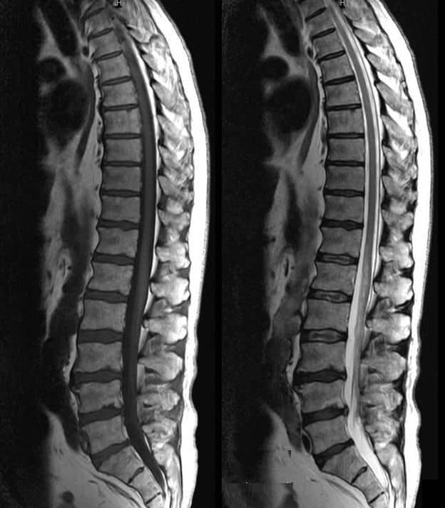 rmn coloana vertebrala pagina de nursing